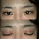 二重埋没 品川美容外科 仙台院 DAY 1 サムネイル用