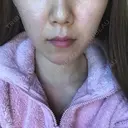 脂肪溶解注射（顔） / その他（肌） The-Clim産婦人科  DAY 4 サムネイル用