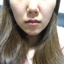 脂肪溶解注射（顔） / その他（肌） The-Clim産婦人科  DAY 5 サムネイル用