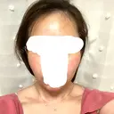 バッカルファット除去 / 脂肪吸引（顔） / ボトックス（あご） / 水光注射（ハリ・美肌） / ヒアルロン酸注入（あご） / ボトックス（エラ・小顔） / 脂肪溶解注射（顔） / ヒアルロン酸注入（唇） エートップ美容整形外科 DAY 46 サムネイル用