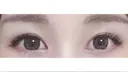目頭切開 / 上まぶたたるみ取り / 眉下切開 Lovelyan整形外科 DAY 83 サムネイル用