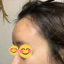 額を丸く / 脂肪注入（額） / 再生医療 / PRP皮膚再生療法 エートップ美容整形外科 DAY 9 サムネイル用