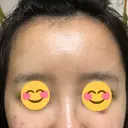 額を丸く / 脂肪注入（額） / 再生医療 / PRP皮膚再生療法 エートップ美容整形外科 DAY 9 サムネイル用