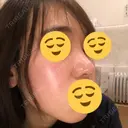 鼻尖形成（切開） / 鼻中隔延長（切開） / 小鼻縮小（切開） / 軟骨移植 / 骨切幅寄せ HANABI整形外科 DAY 211 サムネイル用