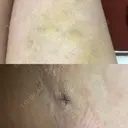 額を丸く / 脂肪注入（額） / 再生医療 / PRP皮膚再生療法 エートップ美容整形外科 DAY 9 サムネイル用