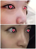 隆鼻術 / 鼻尖形成（切開） / 鼻中隔延長（切開） / 鼻尖縮小 FROM B整形外科 (旧バウム整形外科) DAY 171 サムネイル用