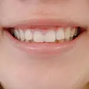 ガミースマイル手術 / その他（口元） 美容皮膚科ピュアビューティー恵比寿 AFTER サムネイル用