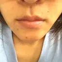 脂肪溶解注射（顔） あらなみクリニック 千葉院 DAY 1 サムネイル用