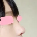 鼻尖形成（切開） / 小鼻縮小（切開） / 軟骨移植 / 骨切幅寄せ HANABI整形外科 DAY 32 サムネイル用