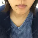 脂肪溶解注射（顔） あらなみクリニック 千葉院 AFTER サムネイル用