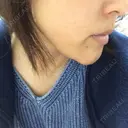 脂肪溶解注射（顔） あらなみクリニック 千葉院 DAY 2 サムネイル用