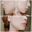 ガミースマイル手術 / ヒアルロン酸注入（唇） / ボトックス（口角） エートップ美容整形外科 DAY 12 サムネイル用