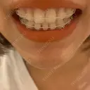 矯正（ワイヤー） ルーセント歯科・矯正歯科 DAY 179 サムネイル用