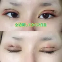 二重切開 GLANZ CLINIC DAY 1 サムネイル用