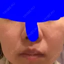 ダーマペン Mスキンクリニック DAY 4 サムネイル用