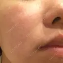 ダーマペン Mスキンクリニック DAY 4 サムネイル用