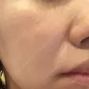 ダーマペン Mスキンクリニック DAY 4 サムネイル用