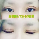 二重切開 GLANZ CLINIC DAY 2 サムネイル用