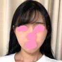 脂肪吸引（顔） / ボトックス（あご） / ヒアルロン酸注入（あご） / ボトックス（エラ・小顔） プチパーティー医院 AFTER サムネイル用