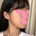 脂肪吸引（顔） / ボトックス（あご） / ヒアルロン酸注入（あご） / ボトックス（エラ・小顔） プチパーティー医院 DAY 89 サムネイル用