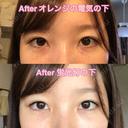 クマ治療 / 下まぶたたるみ取り / 下まぶたの脂肪取り セオリークリニック DAY 38 サムネイル用