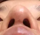 鼻尖形成（切開） / 軟骨移植 湘南美容クリニック 高松院 DAY 14 サムネイル用