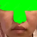 ダーマペン Mスキンクリニック DAY 5 サムネイル用