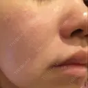 ダーマペン Mスキンクリニック DAY 5 サムネイル用