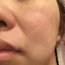 ダーマペン Mスキンクリニック DAY 5 サムネイル用