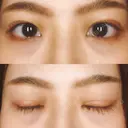 二重埋没 藤・ナチュレ美容クリニック 恵比寿院 DAY 18 サムネイル用