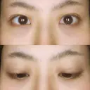 二重埋没 藤・ナチュレ美容クリニック 恵比寿院 DAY 18 サムネイル用