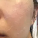 ダーマペン Mスキンクリニック DAY 6 サムネイル用