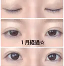 二重埋没 城本クリニック 姫路院 DAY 34 サムネイル用