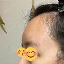 額を丸く / 脂肪注入（額） / 再生医療 / PRP皮膚再生療法 エートップ美容整形外科 DAY 10 サムネイル用