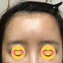 額を丸く / 脂肪注入（額） / 再生医療 / PRP皮膚再生療法 エートップ美容整形外科 DAY 10 サムネイル用