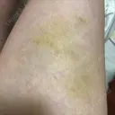 額を丸く / 脂肪注入（額） / 再生医療 / PRP皮膚再生療法 エートップ美容整形外科 DAY 10 サムネイル用