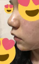 スレッドノーズ リエンジャン整形外科 江南店 DAY 8 サムネイル用