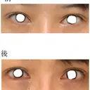 クマ治療 / 下まぶたの脂肪取り ララ整形外科 DAY 0 サムネイル用