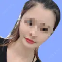 骨削り（エラ） / 骨削り（頬） / 脂肪吸引（顔） F5整形外科 AFTER サムネイル用