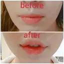 ガミースマイル手術 / ヒアルロン酸注入（唇） / ボトックス（口角） エートップ美容整形外科 AFTER サムネイル用