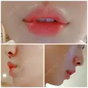 ガミースマイル手術 / ヒアルロン酸注入（唇） / ボトックス（口角） エートップ美容整形外科 DAY 20 サムネイル用