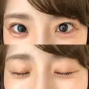 ヒアルロン酸注入（涙袋） 湘南美容クリニック 岐阜院 DAY 1 サムネイル用