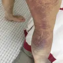 脂肪吸引（脚） / 肌ヒアルロン酸注入（たるみ・シワ改善） プチパーティー医院 DAY 7 サムネイル用