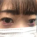 その他（目元） コムロクリニック 東京銀座院 DAY 0 サムネイル用