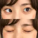 ヒアルロン酸注入（涙袋） 湘南美容クリニック 岐阜院 DAY 2 サムネイル用