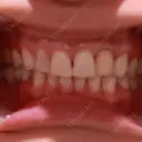 矯正（ワイヤー） / セラミック 東京美容外科 赤坂院 AFTER サムネイル用