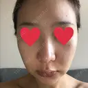 セットバック リッツ美容外科 東京院 DAY 7 サムネイル用