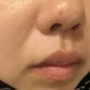 ほくろ・いぼ切除（肌） Mスキンクリニック DAY 0 サムネイル用