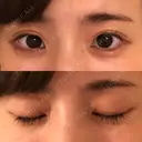 ヒアルロン酸注入（涙袋） 湘南美容クリニック 岐阜院 AFTER サムネイル用