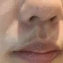 ほくろ・いぼ切除（肌） Mスキンクリニック DAY 1 サムネイル用